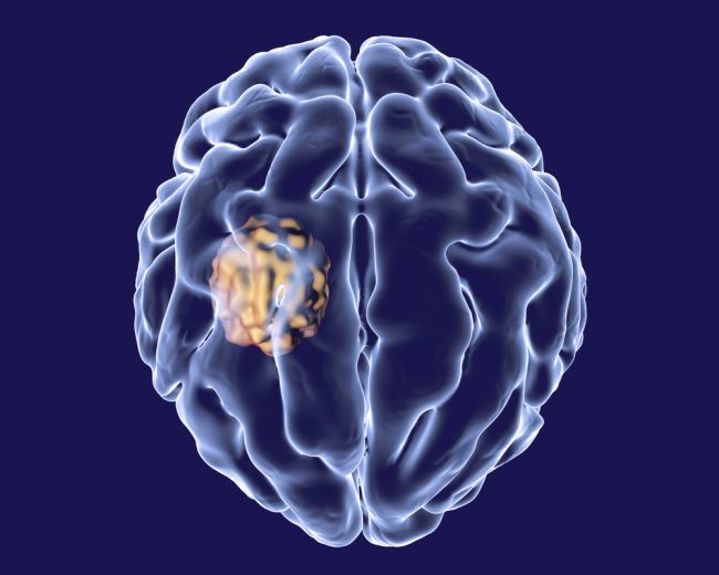 Cysta na mozgu sa môže prejaviť aj takýmito nezvyčajnými príznakmi