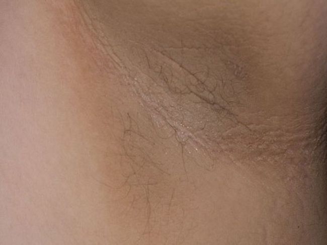 Akantóza: Tieto tmavé škvrny na koži by ste nemali ignorovať