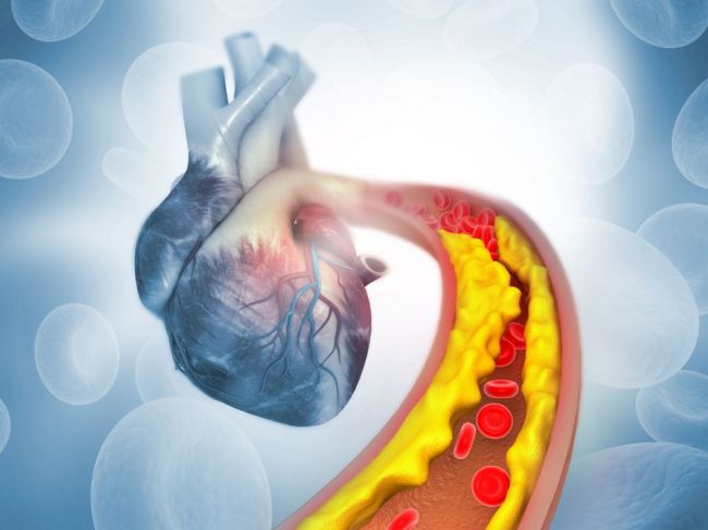 Vysoký cholesterol aj napriek cvičeniu a zdravej strave? Vieme, v čom je problém!