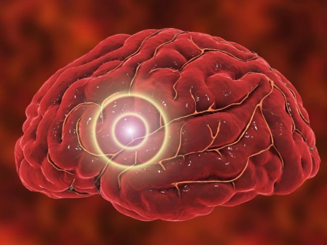 Mozgová aneuryzma: Čo to je, prečo vzniká, a ako ju liečiť?