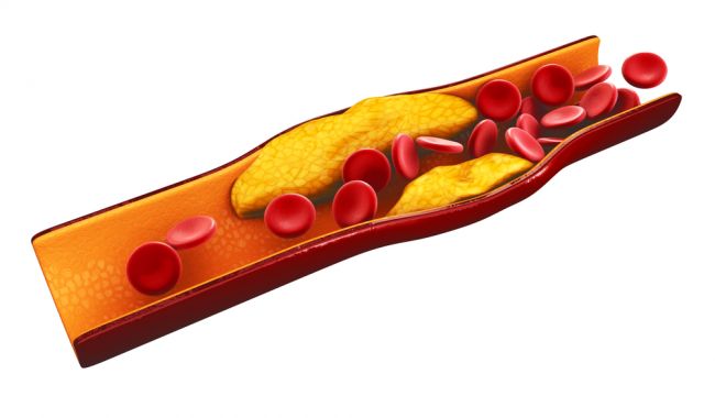 Ako znížiť zlý cholesterol