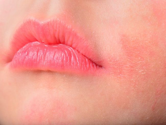 Červené fľaky okolo úst: Čo ich spôsobuje, a ako sa ich zbaviť?