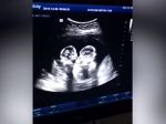 Video: Dvojičky v maternici natočili prostredníctvom ultrazvuku pri zvláštnom správaní