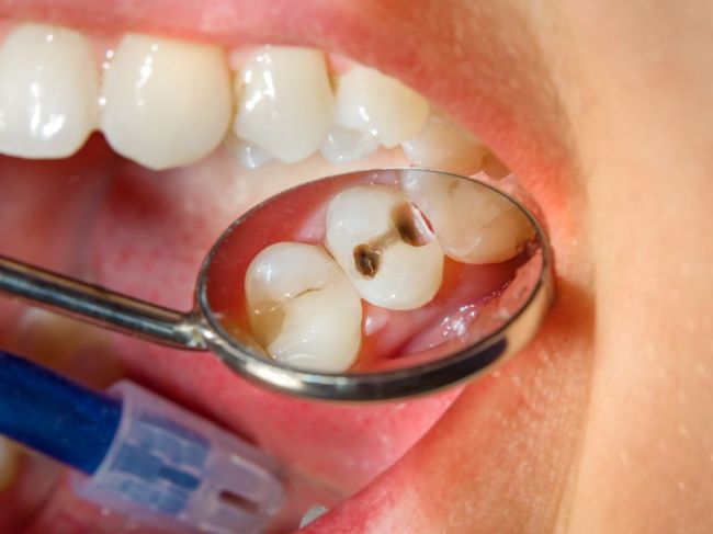 Takúto úlohu hrá imunitný systém pri vzniku zubných kazov 