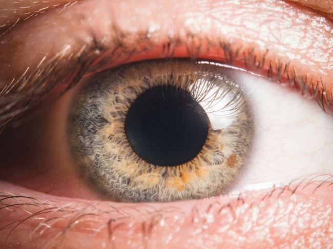 Takéto sfarbenie očí môže signalizovať rakovinu pľúc. Kedy bežať za doktorom?
