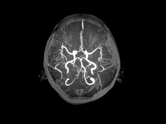 Arteriovenózna malformácia v mozgu: O skrytom ochorení sa mnohí dozvedia neskoro