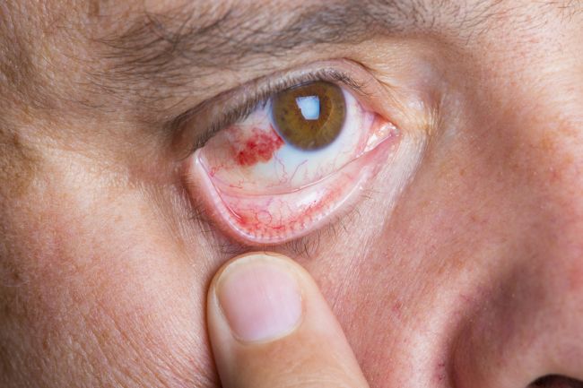 Červená škvrna v oku: Príčiny a ako sa jej zbaviť