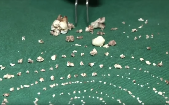 Video: Lekári našli chlapcovi 526 zubov. Takto vyzerali jeho ústa