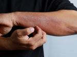 Psoriáza nepostihuje len kožu, dôležitá je správna liečba