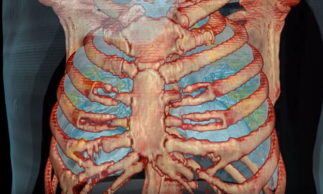 Video: Toto sa deje s pľúcami pacienta infikovaného koronavírusom. Predtým nemal príznaky
