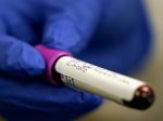 Nové testy určia v krvi prítomnosť protilátok proti koronavírusu