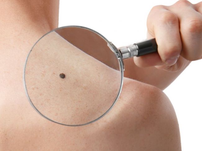5 znakov na znamienku, ktoré prezrádzajú, že ide o rakovinu kože