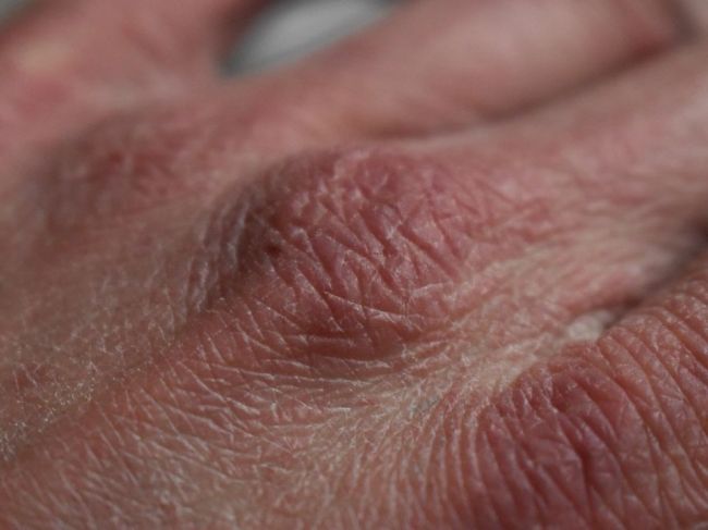 Suchá koža: Dermatológ radí, ako ju správne ošetrovať