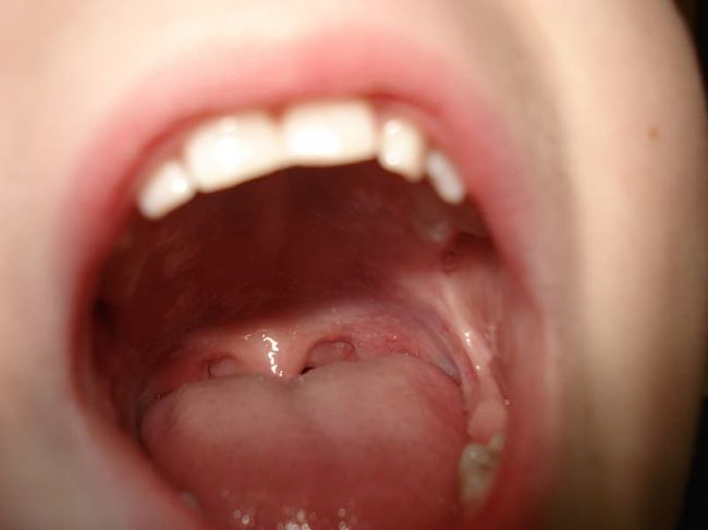 Foto: Lekári odhalili nový príznak koronavírusu - Toto si musíte všímať v ústach