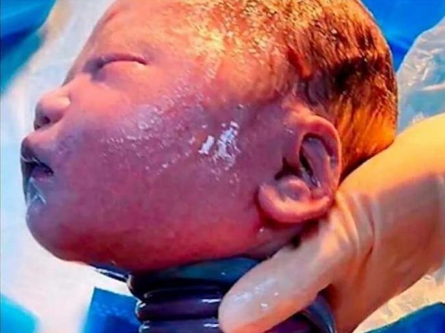 Video: Bábätko šokovalo lekárov, takéto niečo na krku ešte nikdy nevideli
