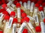 Nemecko hlási trojmesačné maximum nových prípadov nákazy koronavírusom