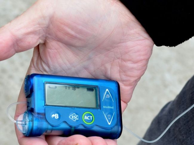 Diabetických pacientov možno na inzulínovú pumpu už aj ambulantne