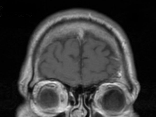 Lekárov prekvapili nálezy v mozgoch pacientov, ktorí zomreli na COVID-19