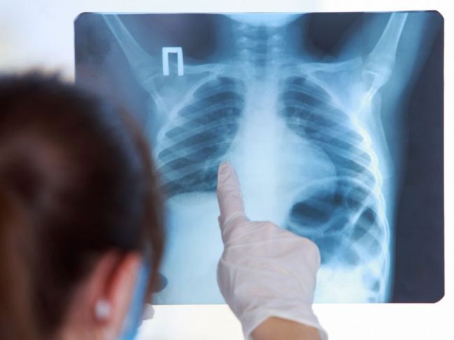 7 faktov, ktoré by ste mali vedieť o zápale pľúc