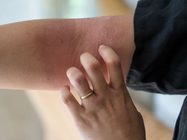 Všedné kožné ochorenie zvyšuje riziko úmrtia zo všetkých ochorení