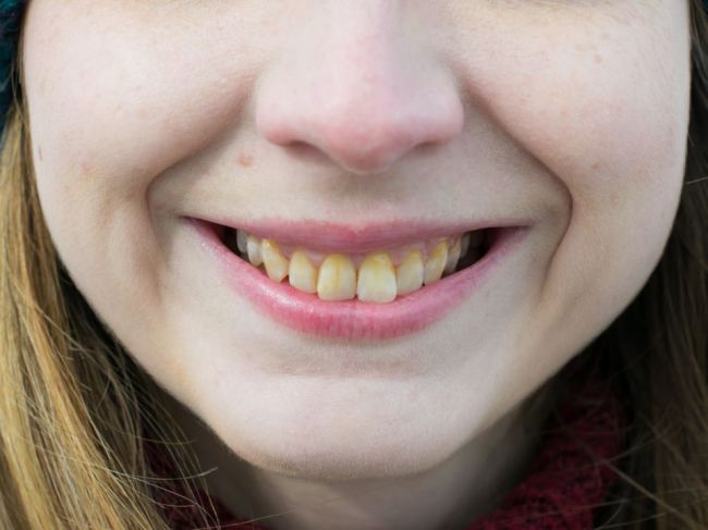 7 bežných chýb, kvôli ktorým vám žltnú zuby