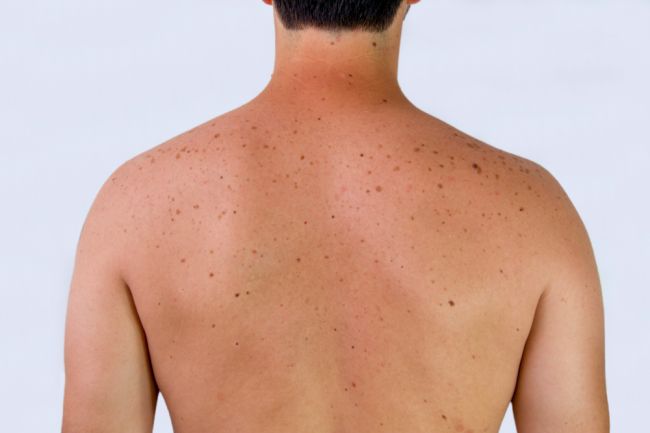 Nemelanómová rakovina kože ohrozuje najmä exteriérových pracovníkov
