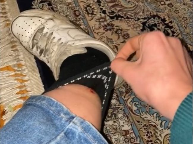 Video: Žena cítila zvláštne šteklenie pod ponožkou. Potom spustila krik
