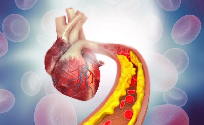 Zvýšený cholesterol sa týka čoraz viac mladých ľudí