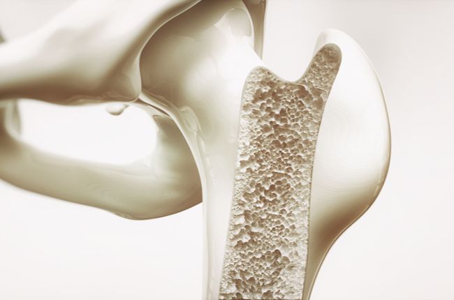 Na vznik osteoporózy vplýva aj alkohol a fajčenie