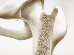Na vznik osteoporózy vplýva aj alkohol a fajčenie