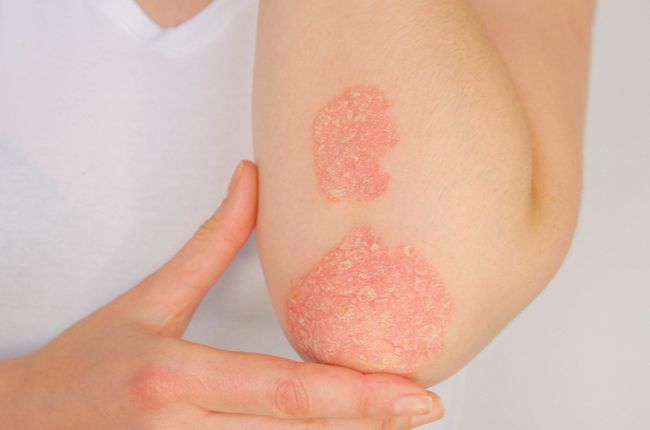 Na vzniku psoriázy sa podieľa genetika, stres aj životný štýl
