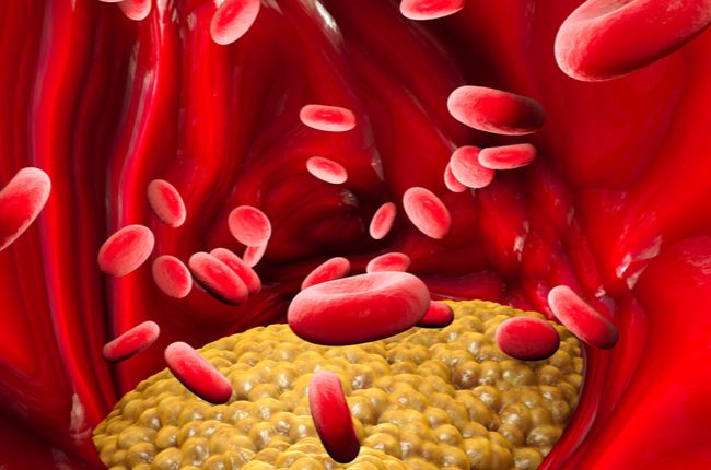 Dyslipidémia: Tieto nápoje zvyšujú triglyceridy a znižujú dobrý cholesterol