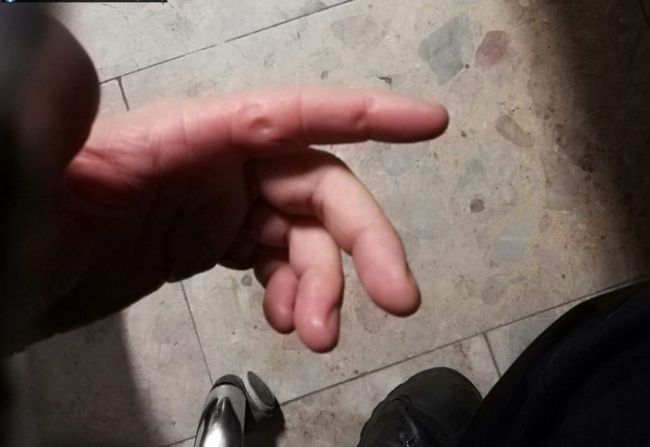 Opitý a agresívny muž sa pri spacifikovaní zahryzol policajtovi do ruky