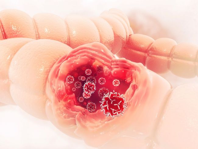 Rakovine hrubého čreva a konečníka sa dá predísť, dôležitá je prevencia