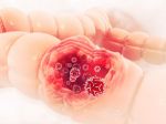 Rakovine hrubého čreva a konečníka sa dá predísť, dôležitá je prevencia