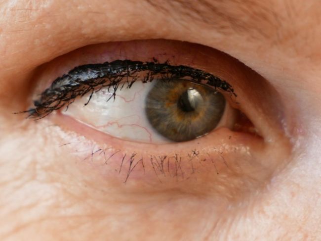 Zelený zákal sa môže končiť slepotou, dôležitá je prevencia