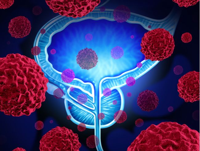 Vedci objavili baktérie, ktoré môžu súvisieť s rakovinou prostaty