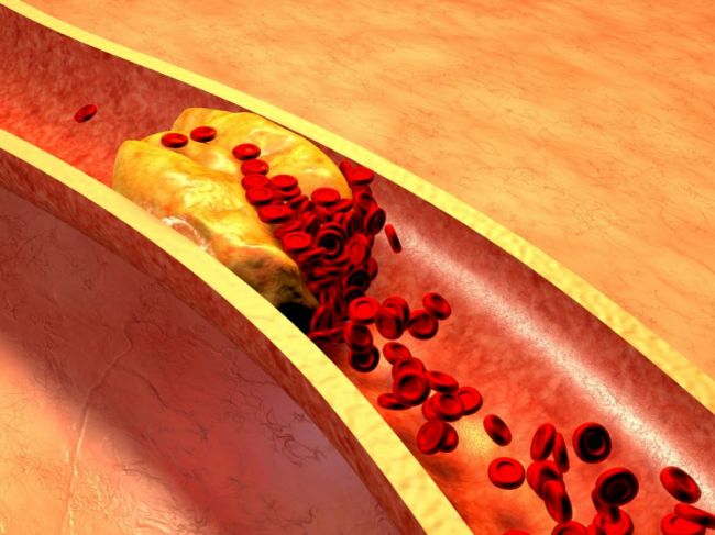 3 zmeny životného štýlu, ktoré vám zaručia ochranu pred vysokým cholesterolom