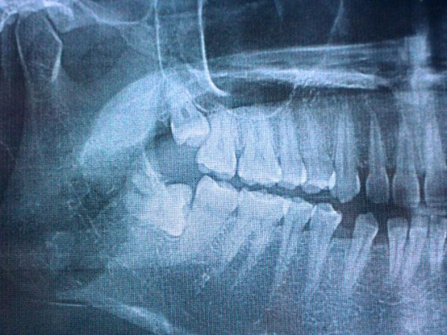 ​Pacient na prehliadke u zubára zistil, že má čierne kosti. Bizarný incident súvisí s akné