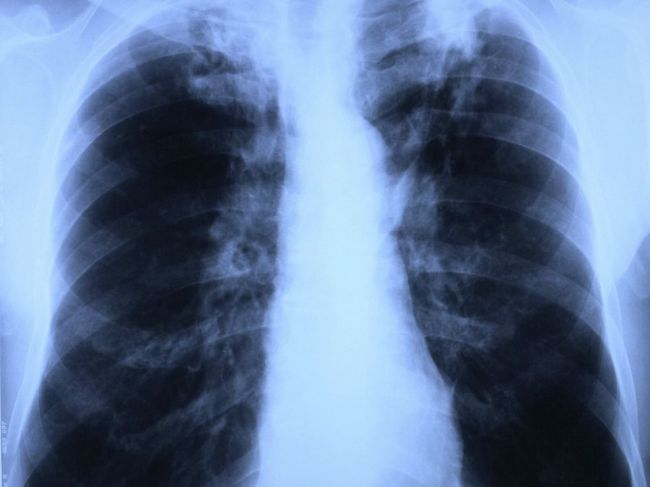 V Hranovnici zachytili počas vyšetrení tri prípady TBC