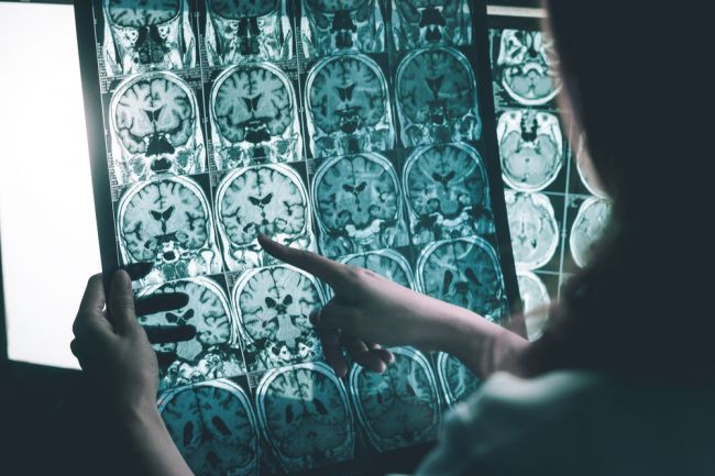 Česká lekárka: Alzheimerova choroba postihuje čoraz mladších ľudí