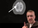 Muž so skrytým nádorom na mozgu varuje: Tieto príznaky neignorujte
