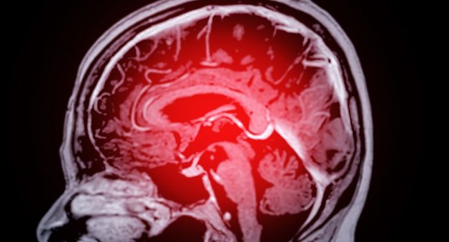 Častý zlozvyk môže viesť k zápalu mozgu a Alzheimerovej chorobe