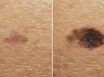 Video: Takto sa škvrna na koži dokáže zmeniť na melanóm. Na tieto znaky si dávajte pozor
