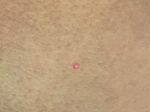 Pozor na červené bodky na koži, takto sa z nich môže stať rakovina